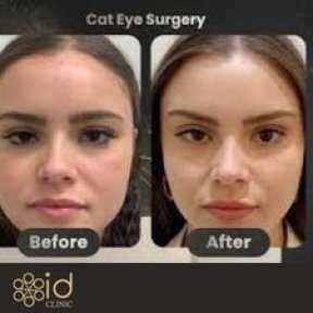 Before and after cat eye surgery results at ID Clinic Bangkok, lifted eye shape transformation