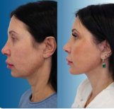 Résultats avant/après du contouring du visage à Memorial Şişli Hospital, mâchoire affinée