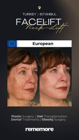Résultats avant/après lifting visage et cou à Memorial Şişli Hospital, rajeunissement visible