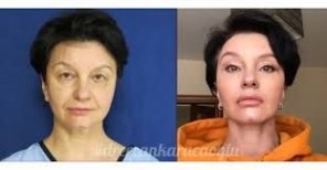 Résultats avant/après du contouring du visage à Memorial Şişli Hospital, rajeunissement facial