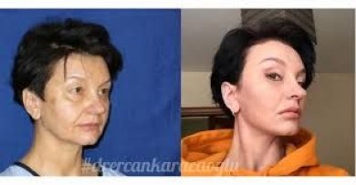 Résultats avant/après du contouring du visage à Memorial Şişli Hospital, traits affinés