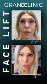 Before and after facelift results at Grand Clinic – visible facial rejuvenation and tightening