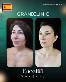 Before and after facelift surgery results at Grand Clinic – visible facial rejuvenation