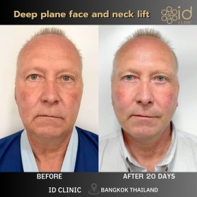 Before and after deep plane facelift and neck lift results at ID Clinic Bangkok, 20 days post-op