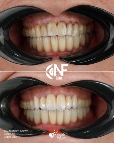 Before and after zirconium crowns on upper jaw at Nifa Dent International, smile makeover result