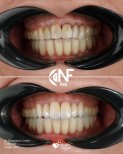 Before and after zirconium crowns on upper jaw at Nifa Dent International, smile makeover result