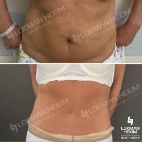 Before and after tummy tuck and liposuction results at Lokman Hekim Istanbul Hospital