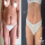 Before and after tummy tuck and liposuction results at Lokman Hekim Istanbul Hospital