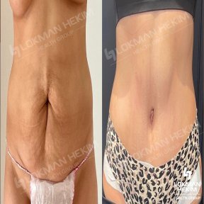 Before and after tummy tuck and liposuction results at Lokman Hekim Istanbul Hospital
