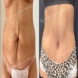Before and after tummy tuck and liposuction results at Lokman Hekim Istanbul Hospital