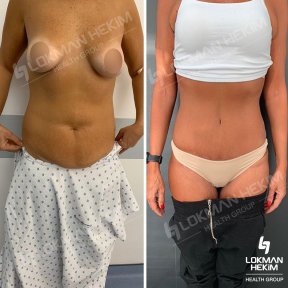 Before and after tummy tuck and liposuction results at Lokman Hekim Istanbul Hospital