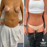 Before and after tummy tuck and liposuction results at Lokman Hekim Istanbul Hospital