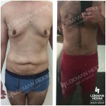 Before and after tummy tuck and liposuction results at Lokman Hekim Istanbul Hospital