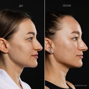 Deep plane facelift before and after results at Vidnova Clinic – visible facial contour lift