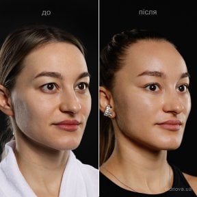 Deep plane facelift before and after results at Vidnova Clinic – visible facial rejuvenation
