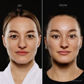 Before and after deep plane facelift results at Vidnova Clinic – visible facial rejuvenation