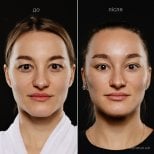 Before and after deep plane facelift results at Vidnova Clinic – visible facial rejuvenation
