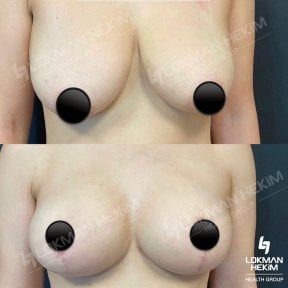 Before and after mammoplasty results at Lokman Hekim Istanbul Hospital, breast lift and contour