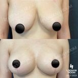 Before and after mammoplasty results at Lokman Hekim Istanbul Hospital, breast lift and contour