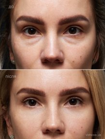 before-after photo lower-eyelid-surgery