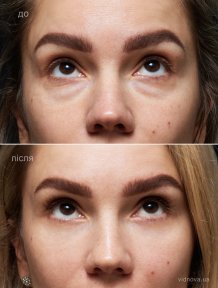 before-after photo lower-eyelid-surgery