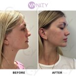 نتائج عملية تجميل الأنف قبل وبعد في VANITY COSMETIC SURGERY HOSPITAL، إعادة تشكيل الأنف
