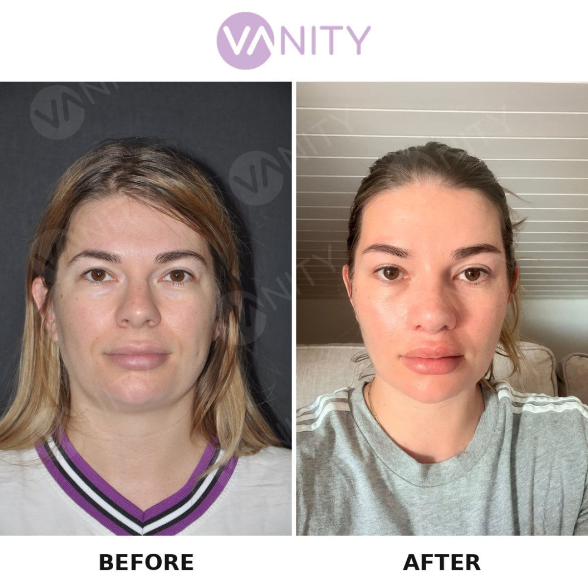 Resultado antes y después de extracción de grasa bucal en VANITY COSMETIC SURGERY HOSPITAL, mejillas más delgadas
