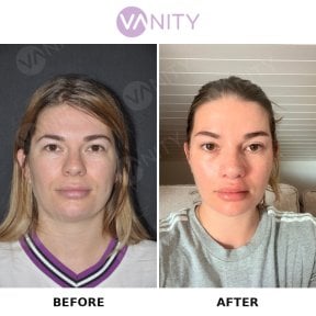 Результат до и после удаления комков Биша в VANITY COSMETIC SURGERY HOSPITAL, более стройные щеки