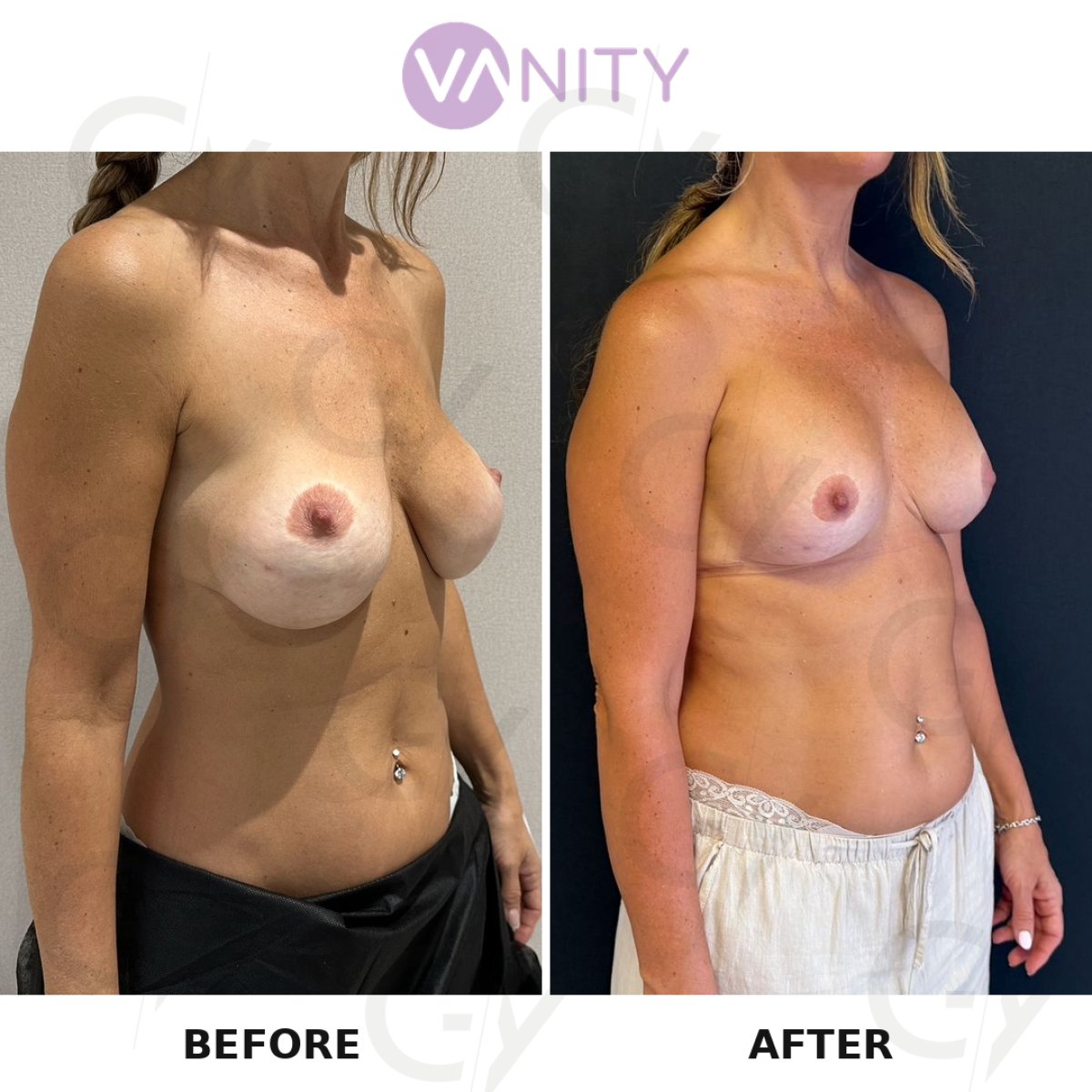 نتائج قبل وبعد تصحيح زرع الثدي في VANITY COSMETIC SURGERY HOSPITAL