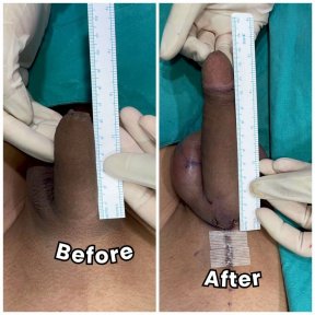 before-after photo platelet-rich-plasma-prp-therapy