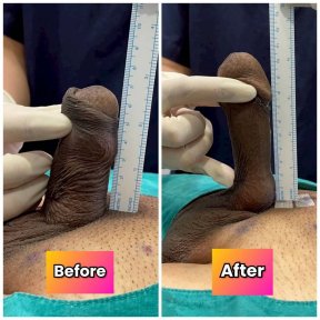 before-after photo platelet-rich-plasma-prp-therapy