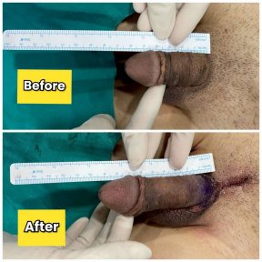 before-after photo platelet-rich-plasma-prp-therapy