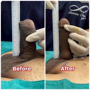 before-after photo platelet-rich-plasma-prp-therapy