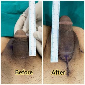 before-after photo platelet-rich-plasma-prp-therapy