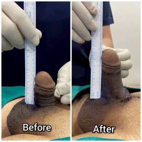before-after photo platelet-rich-plasma-prp-therapy