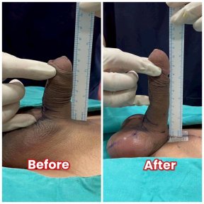 before-after photo platelet-rich-plasma-prp-therapy