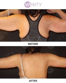 نتائج شد الذراعين قبل وبعد في VANITY COSMETIC SURGERY HOSPITAL، تحسين شكل الذراع