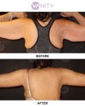 نتائج شد الذراعين قبل وبعد في VANITY COSMETIC SURGERY HOSPITAL، تحسين شكل الذراع