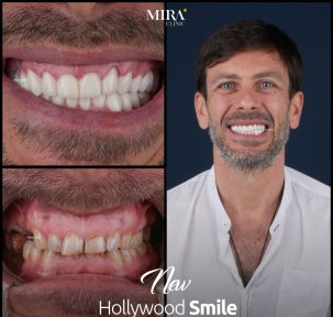 before-after photo all-on-6-dental-implants
