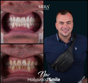 before-after photo all-on-6-dental-implants