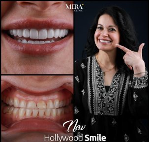 before-after photo all-on-6-dental-implants