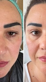 before-after photo tightening-of-facial-skin-facelift