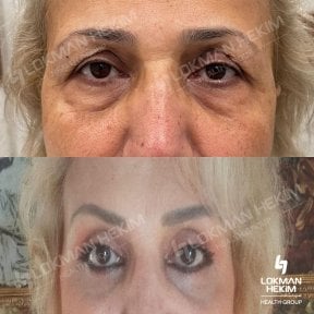 before-after photo tightening-of-facial-skin-facelift