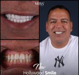 Before and after veneers result at Mira Clinic – Hollywood Smile transformation for men