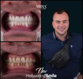 Before and after dental veneers result at Mira Clinic, Hollywood Smile transformation