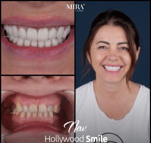 Before and after veneers results at Mira Clinic, Hollywood Smile transformation for woman