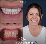 Before and after veneers results at Mira Clinic, Hollywood Smile transformation for woman