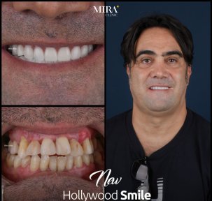 Before and after veneers result at Mira Clinic, Hollywood Smile transformation for male patient