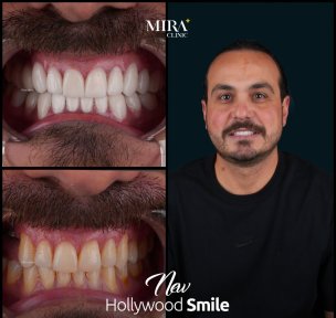 Before and after veneers results at Mira Clinic, Hollywood Smile transformation for male patient