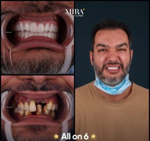 before-after photo all-on-4-dental-implants